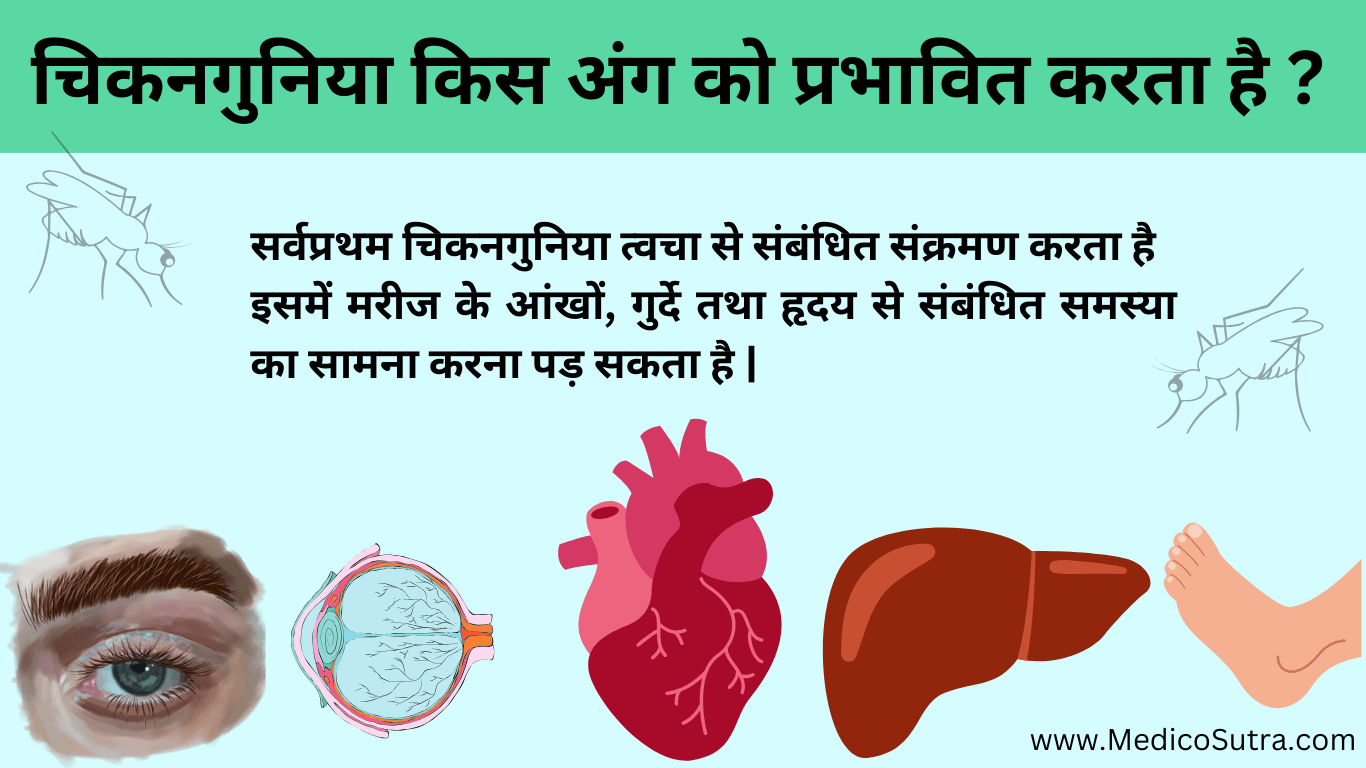 चिकनगुनिया कारण, लक्षण और उपचार 