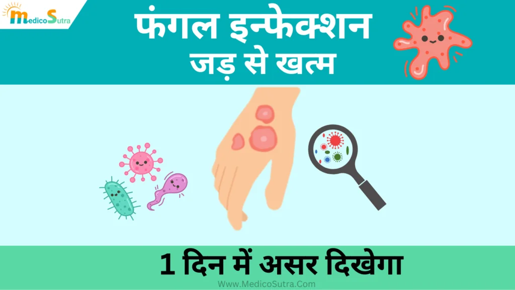 फंगल इन्फेक्शन को जड़ से खत्म करने के लिए क्या करें