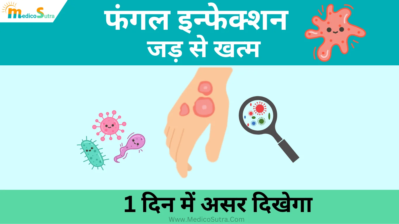 फंगल इन्फेक्शन को जड़ से खत्म करने के लिए क्या करें