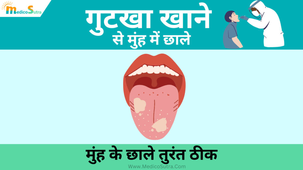 गुटखा खाने से मुंह में छाले का इलाज; 1 दिन में मुंह के छाले तुरंत ठीक, जानें 10 घरेलू उपाय: Mouth Ulcer » MedicoSutra गुटखा खाने से मुंह में छाले का इलाज