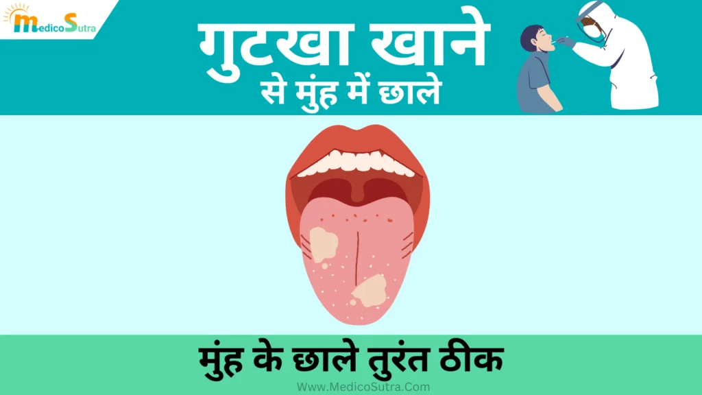 गुटखा खाने से मुंह में छाले का इलाज