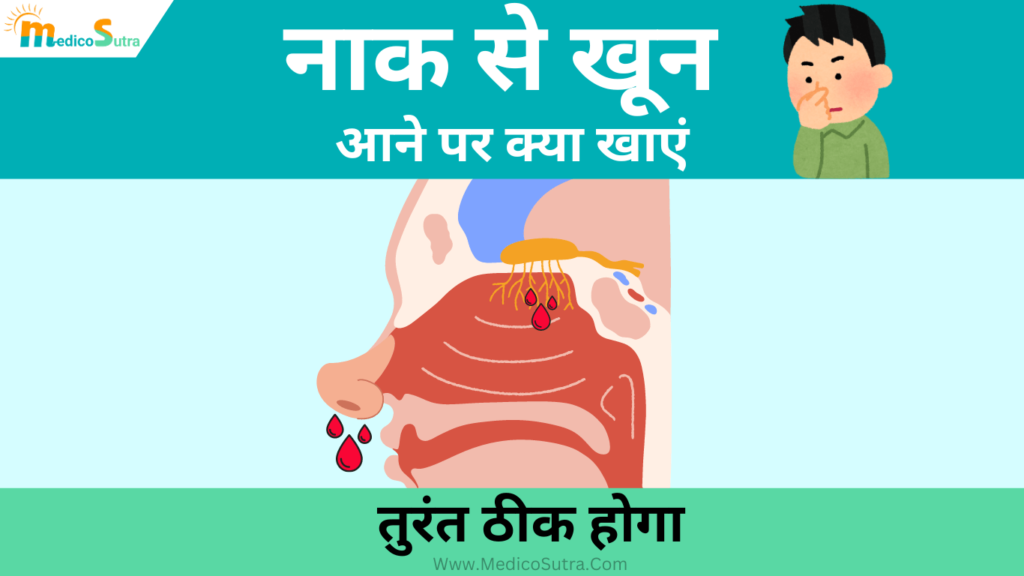 नाक से खून आने पर क्या खाना चाहिए; दुबारा नकसीर फूटना रोकेगा, सर्दी हो या गर्मी; जानें 10 घरेलू उपाय » MedicoSutra नाक से खून आने पर क्या खाना चाहिए
