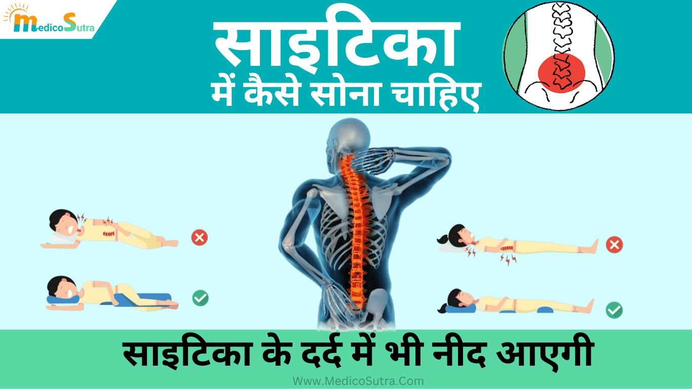 साइटिका में कैसे सोना चाहिए; 3 तरीको से साइटिका के दर्द में भी नीद आएगी, Sciatica Pain » MedicoSutra साइटिका में कैसे सोना चाहिए, Sciatica me kaise sona chahiye