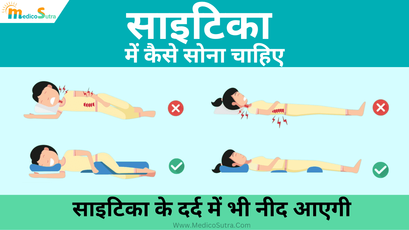 साइटिका में कैसे सोना चाहिए; 3 तरीको से साइटिका के दर्द में भी नीद आएगी, Sciatica Pain » MedicoSutra साइटिका में कैसे सोना चाहिए, Sciatica me kaise sona chahiye