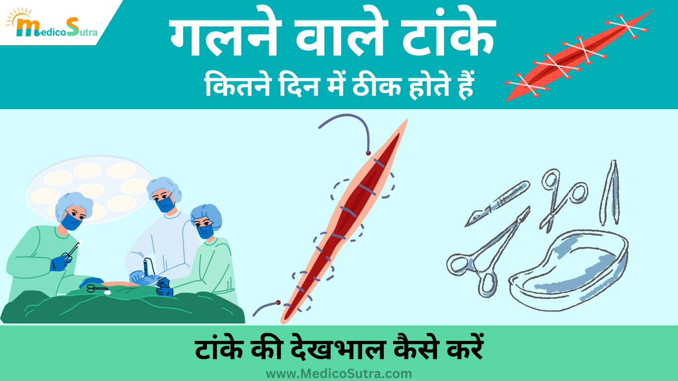 गलने वाले टांके कितने दिन में ठीक होते हैं; ऐसी 5 गलती मत करना, जाने सर्जरी के बाद टांके की देखभाल कैसे करें » MedicoSutra गलने वाले टांके कितने दिन में ठीक होते हैं