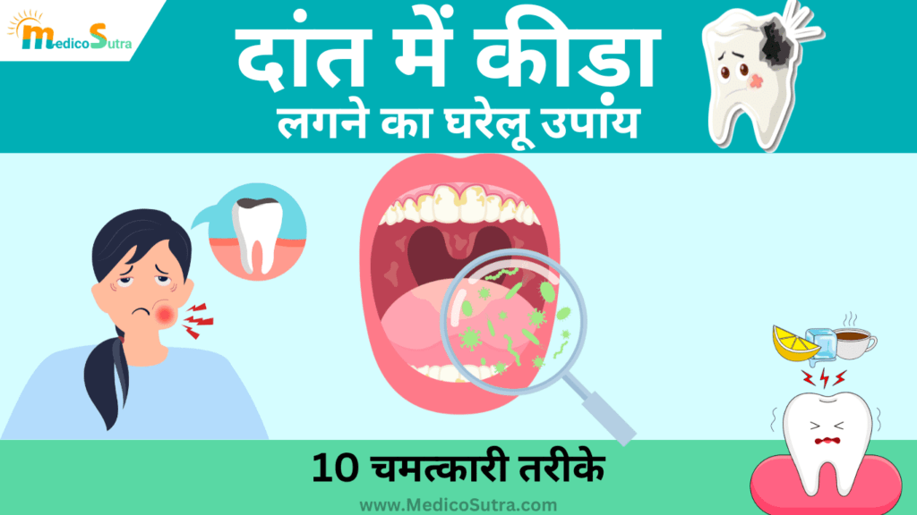 दांत में कीड़ा लगने का घरेलू उपाय; 10 चमत्कारी तरीके, दांतों का काल कीड़ा जड़ से हटाने में असरदार  » MedicoSutra दांत में कीड़ा लगने का घरेलू उपाय