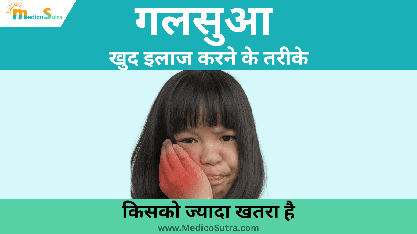 गलसुआ का खुद इलाज करने के तरीके; 10 देसी व घरेलू इलाज, और गलसुआ में क्या नहीं खाना चाहिए » MedicoSutra गलसुआ का खुद इलाज करने के तरीके