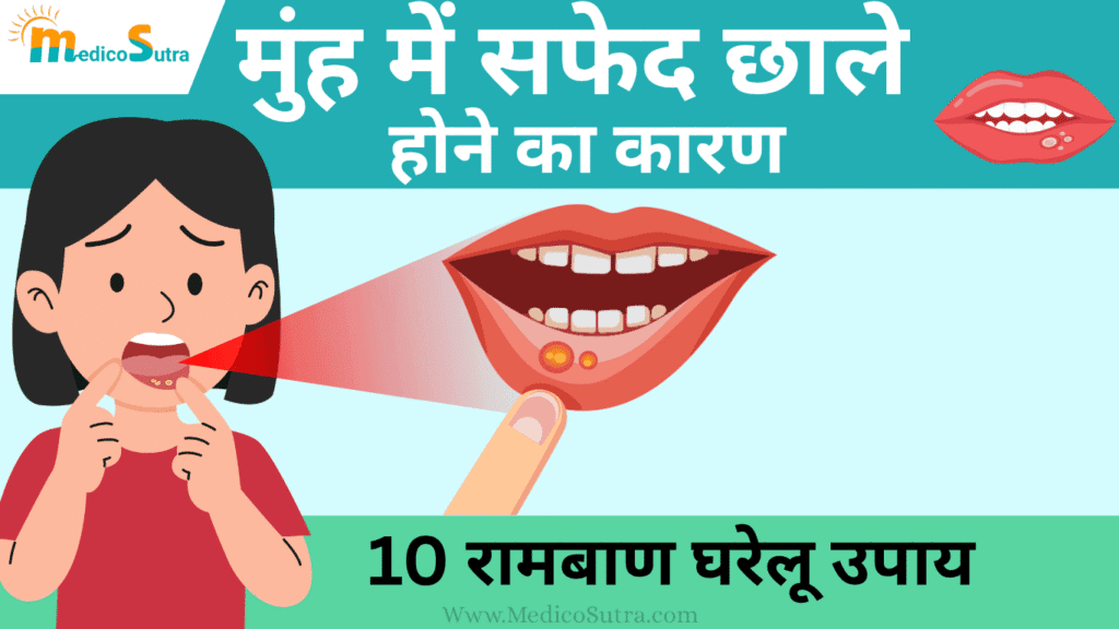 मुंह में सफेद छाले होने का कारण और 10 घरेलू उपाय; बार-बार छाले होने से रोक सकता है।