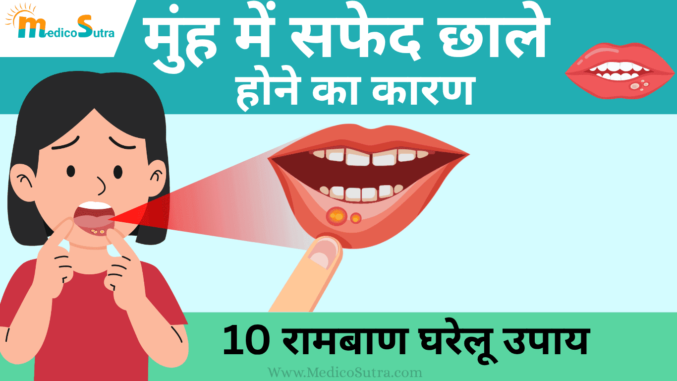 मुंह में सफेद छाले होने का कारण और 10 घरेलू उपाय; बार-बार छाले होने से रोक सकता है।
