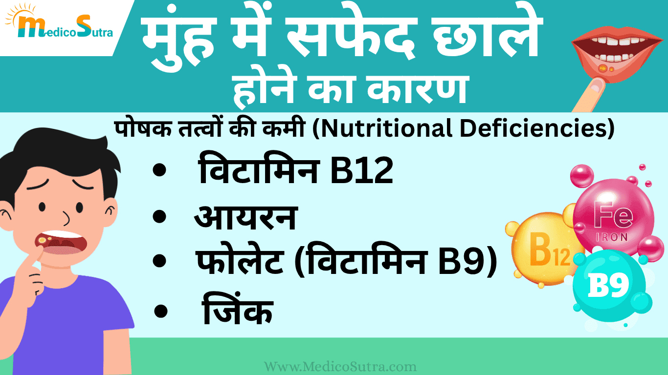 मुंह में सफेद छाले होने का कारण और 10 घरेलू उपाय; बार-बार छाले होने से रोक सकता है।